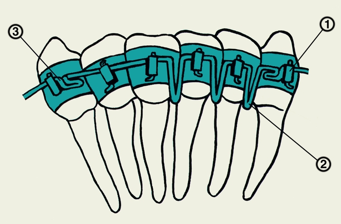 Рис. 6. Схематическое изображение наложения аппарата Бегга на нижний зубной ряд: 1 — упругая вертикальная петля; 2 — замковое крепление; 3 — кольцо для фиксации аппарата на зубах