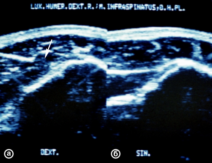 Рис. 17. Ультрасонограммы плечевых суставов (задний горизонтальный срез) при разрыве <a href=