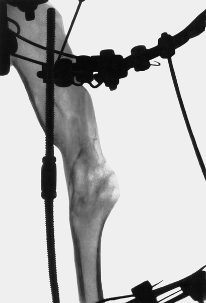Рис. 38в). Рентгенограмма плечевой кости при дисхондроплазии в процессе лечения: укорочение плечевой кости компенсировано в результате дистракции, виден <a href=