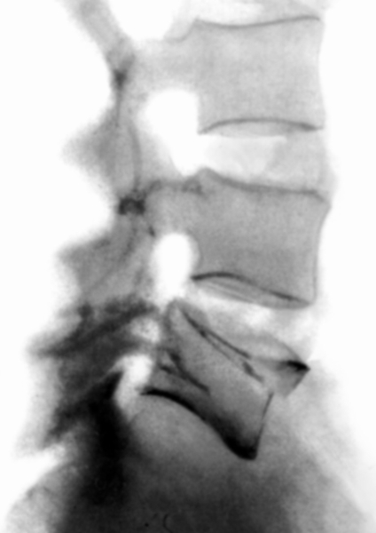 Рис. 9. Рентгенограмма нижнегрудного отдела позвоночника (боковая проекция) при переломовывихе