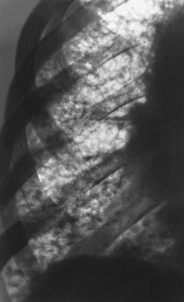 Рис. 6. Фрагмент рентгенограммы грудной клетки при интерстициальном пневмосклерозе с преимущественным поражением альвеолярной соединительной ткани (фиброзирующий <a href=