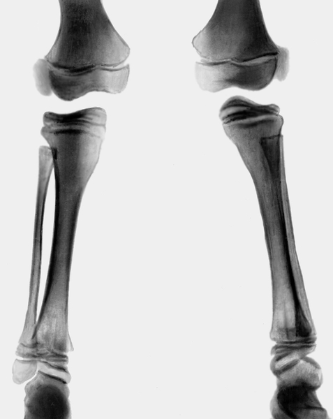 Рис. 12. Рентгенограмма коленных суставов и голеней при хондроэктодермальной дисплазии: наружные эпифизы большеберцовых костей скошены, двусторонняя вальгусная деформация голеней