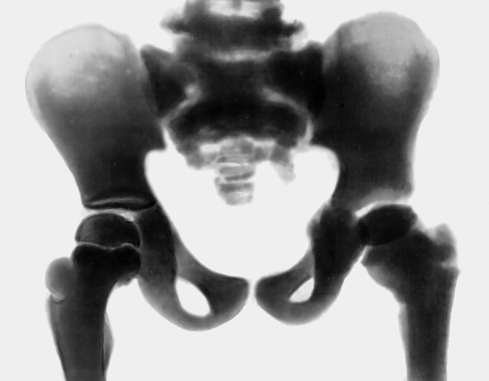 Рис. а). Рентгенограмма костей таза при врожденной мраморной болезни: избыточное развитие компактного вещества, очаги склерозирования костной ткани и уплотнение ее структуры в различных костях скелета
