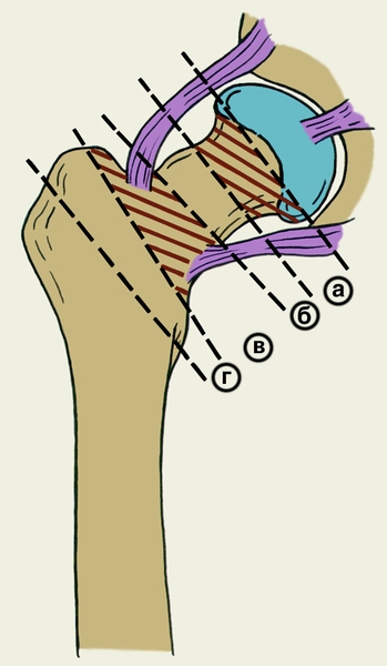 Рис. 4. Схема уровней переломов шейки бедренной кости по Каплану. Медиальные переломы: а — субкапитальный, б — трансцервикальный. Латеральные переломы: в — межвертельный, г — чрезвертельный.