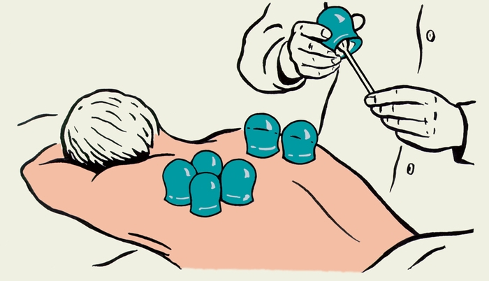 Рис. б). Схематическое изображение процедуры постановки медицинских банок: банки на спине больного