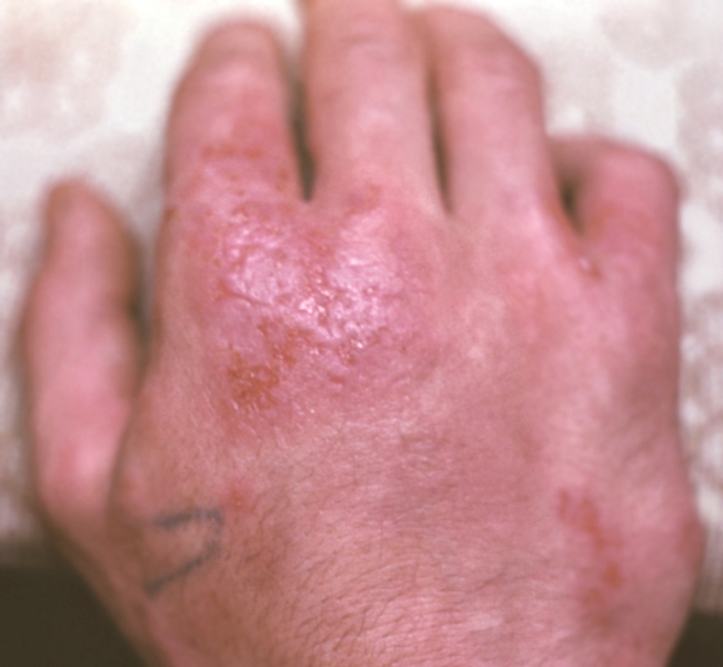 Рис. 4. Аллергический дерматит, вызванный применением раствора йода: буллезные высыпания на фоне эритемы на тыльной поверхности кисти