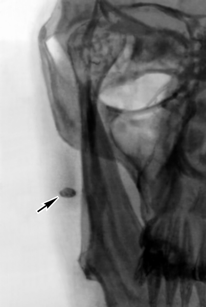 Рентгенограмма области правой околоушной железы при сиалолитиазе (передняя прямая проекция); стрелкой указан слюнной камень, локализующийся в выводном протоке железы