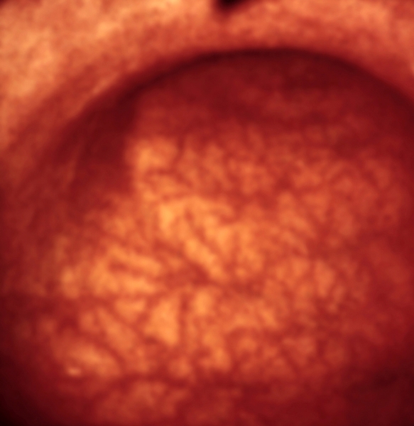Рис. 4. Эндоскопическая картина желудка в норме и при различных заболеваниях. Атрофический гастрит: слизистая оболочка желудка бледная, истонченная, через нее просвечивают <a href=