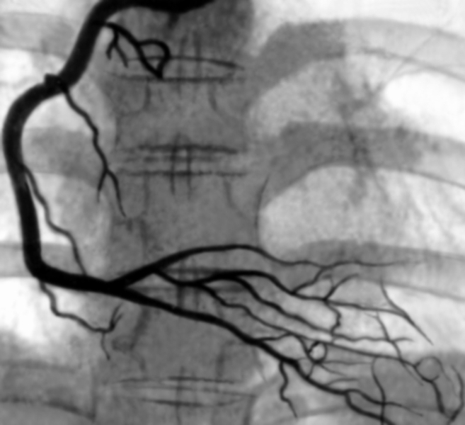 Рис. 1. Ангиограмма правой венечной артерии в норме (прямая проекция)