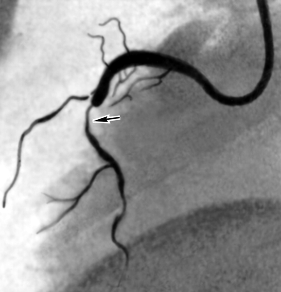 Рис. 3. Ангиограмма правой венечной артерии при стенозе (боковая проекция; место сужения указано стрелкой)