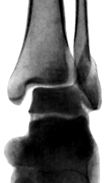 Рис. 4а). Рентгенограмма голеностопных суставов при переломах образующих их костей: перелом наружной лодыжки (прямая проекция)