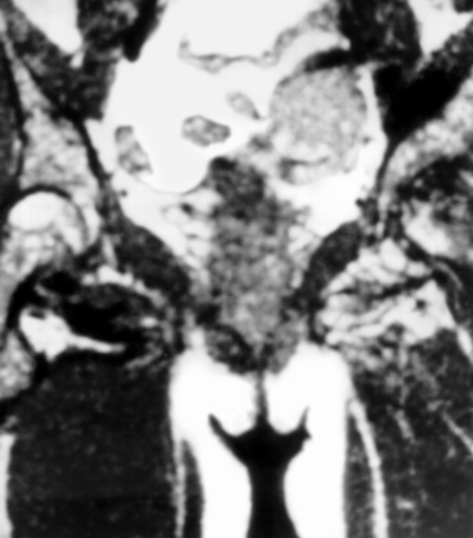 Рис. 29. Ядерно-магнитно-резонансная томограмма тазобедренных суставов при асептическом некрозе головки левой бедренной кости