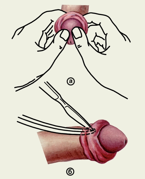 Схематическое изображение вправления головки полового члена (а) и рассечения ущемляющего кольца (б) при парафимозе