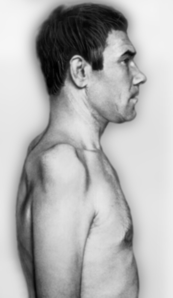 Рис. 3а). Больной с поражением верхнего ствола плечевого сплетения: вид сбоку (справа), атрофия дельтовидной, надлопаточной, надостной и частично двуглавой мышц плеча