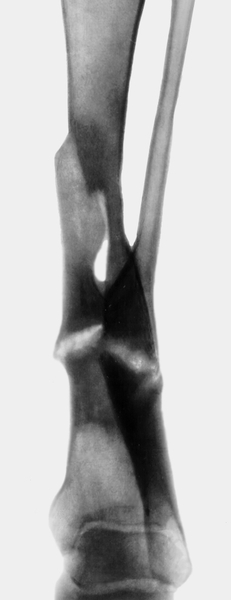 Рис. 20а). Рентгенограмма голени больного с хроническим посттравматическим остеомиелитом в прямой проекции: виден сформированный ложный сустав