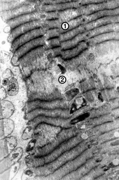 Рис. 3а). Микропрепарат миокарда (×400) в поляризованном свете: 1 — контрактурные повреждения кардиомиоцитов в виде усиления анизотропии и слияния А-дисков; 2 — релаксация саркомеров