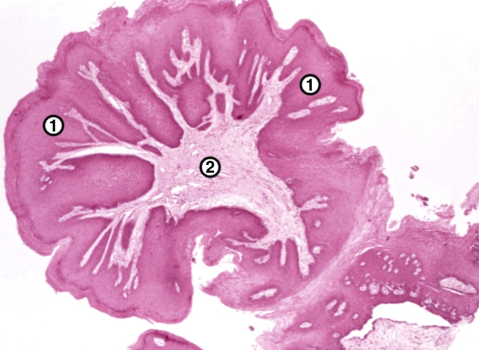 Рис. 1. Микропрепарат папилломы слизистой оболочки полости рта: 1 — поверхность папилломы, покрытая многослойным плоским эпителием; 2 — соединительнотканная строма. <a href=