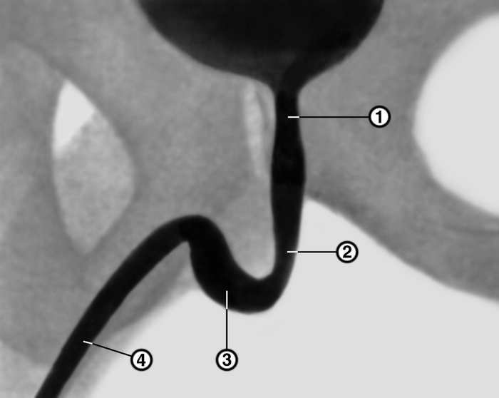 Рис. 1. Нисходящая уретроцистограмма в норме: 1 — предстательная часть уретры; 2 — перепончатая часть; 3 — луковичная часть; 4 — губчатая часть