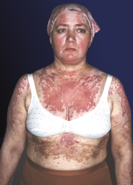 Рис. 6. Синдром Роуэлла у больной системной красной волчанкой: множественные высыпания, характеризующиеся сильной отечностью, симулирующие многоформную экссудативную эритему