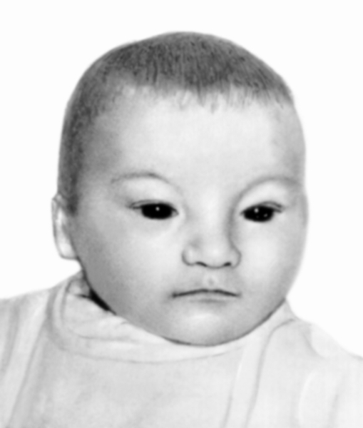 Рис. 2а). Ребенок с синдромом Лежена в возрасте 4 дней: лунообразное лицо, косой разрез глаз с опущенными наружными углами, несколько уплощенный нос, низко расположенные ушные раковины