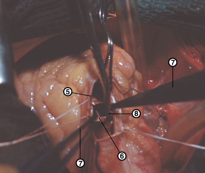 Рис. 32б). Этапы операции комиссуротомии по поводу клапанного стеноза легочного ствола (выполняется на работающем сердце в условиях гипотермии с кратковременным прекращением венозного притока): клапан рассечен по одной из комиссур (5), его створки (6) фиксированы пинцетами (7), ножницами рассекается вторая сросшаяся <a href=