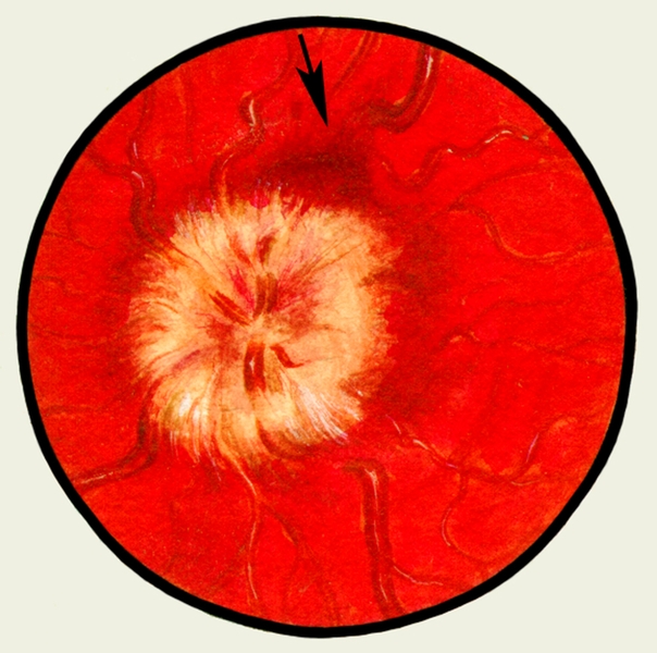 Рис. 2. Глазное дно в норме и при патологии. Застойный сосок: диск зрительного нерва отечен, с нечеткими границами, венозные сосуды резко расширены, полнокровны, у верхнего края диска стрелкой указано кровоизлияние