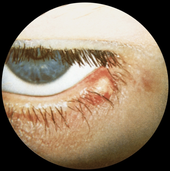 Ячмень нижнего века левого глаза: виден воспалительный очаг желтоватого цвета, вокруг которого определяются отек и гиперемия
