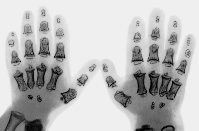 Рис. 28. Рентгенограммы кистей при псевдоахондроплазии: позднее появление ядер окостенения костей запястья, укорочение пястных костей и фаланг пальцев, метафизы пястных костей расширены