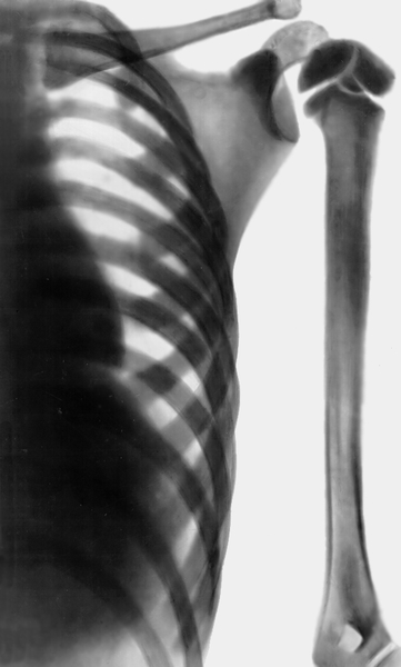 Рис. б). Рентгенограмма плечевого пояса и грудной клетки при врожденной мраморной болезни: избыточное развитие компактного вещества, очаги склерозирования костной ткани и уплотнение ее структуры в различных костях скелета