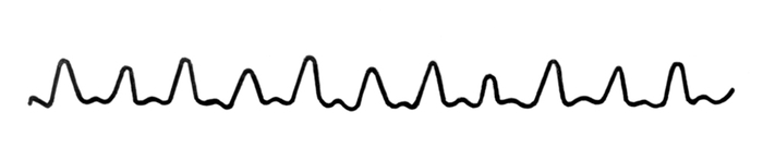 Рис. 4. Артериальная сфигмограмма, отображающая альтернирующий пульс: пульсовые волны большой и малой амплитуды чередуются