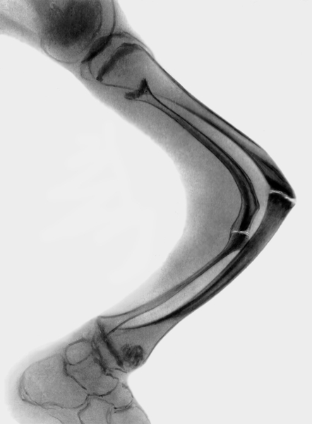 Рис. 39а). Рентгенограмма костей голени при несовершенном остеогенезе: <a href=