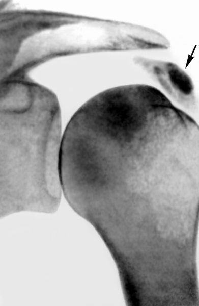 Рис. 2. Ретгенограмма плечевого сустава (прямая проекция) при кальцифицирующем бурсите: кальцинат в области сухожилия надостной мышцы указан стрелкой