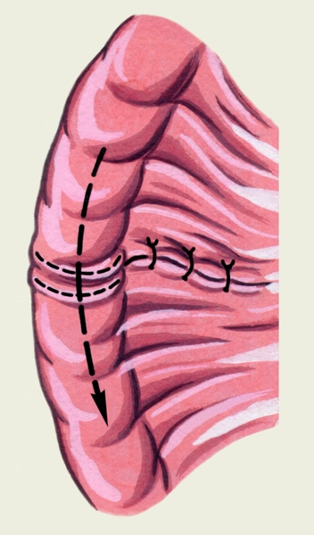 Рис. 7б). Схематическое изображение различных видов кишечного анастомоза: анастомоз конец в конец; стрелкой показано направление продвижения кишечного содержимого