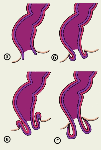 Схематическое изображение области заднего прохода на разрезе при выпадении прямой кишки: а — выпадение слизистой оболочки анального канала (I степень); б — выпадение заднего прохода (II степень); в — выпадение прямой кишки (III степень); г — выпадение прямой кишки и заднего прохода (IV степень)