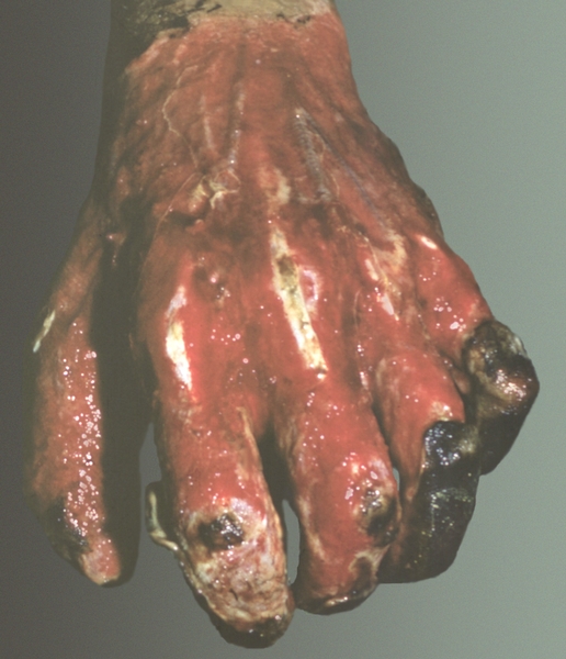 Рис. 6. Отторжение некротизированных тканей и развитие грануляций в ожоговой ране