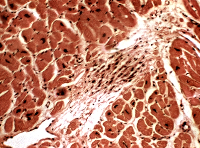 Рис. 2. Микропрепарат миокарда при ревматизме: среди гипертрофированных мышечных волокон располагается крупная ревматическая гранулема. <a href=