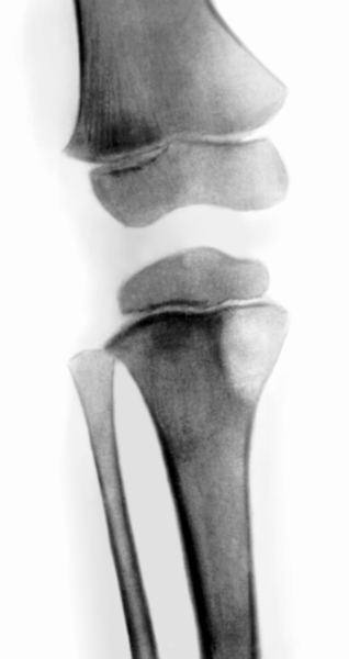 Рис. 4а). Динамика развития аневризмальной кисты кости: эксцентрическая форма аневризмальной кисты большеберцовой кости в фазе остеолиза у ребенка 6 лет, <a href=