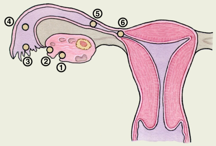 Рис. 1. Схематическое изображение вариантов имплантации оплодотворенной яйцеклетки при внематочной беременности: 1, 2 — в яичнике; 3, 4 — в ампулярной части трубы; 5 — в перешеечной части трубы; 6 — в межуточной части трубы