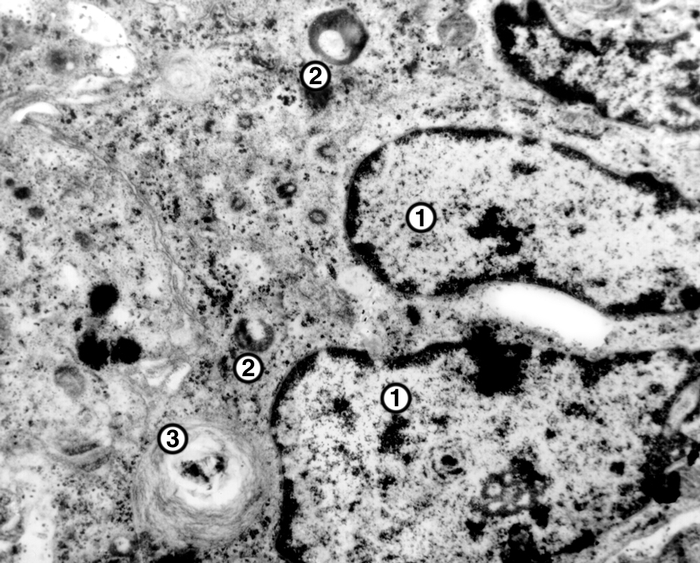 Рис. 1. Электронограмма участка гигантской многоядерной клетки инородных тел: 1 — ядра, входящие в состав одной клетки; 2 — лизосомы; 3 — фагосомы; ×15000