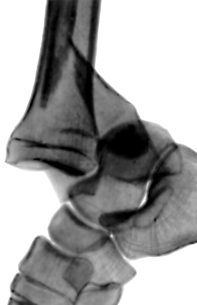 Рис. 4е). Рентгенограмма голеностопных суставов при переломах образующих их костей: перелом наружной лодыжки с разрывом межберцового синдесмоза и вывихом стопы кзади (боковая проекция)