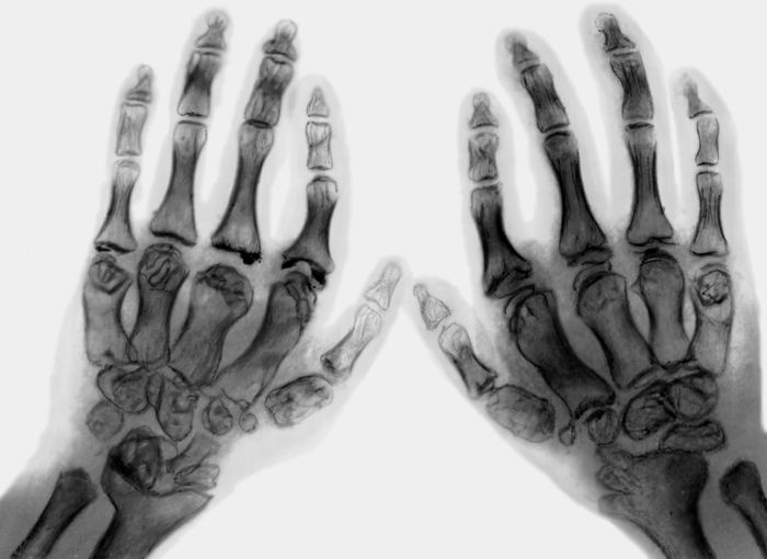 Рис. 4б). Рентгенограмма кистей рук при диастрофической дисплазии: укорочение пястных костей, первая пястная кость имеет округлую форму