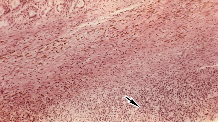 Рис. 3в). Микропрепарат почки при остром гнойном пиелонефрите: лейкоцитарная инфильтрация паранефральной клетчатки (указана стрелкой); окраска гематоксилином и эозином; ×80