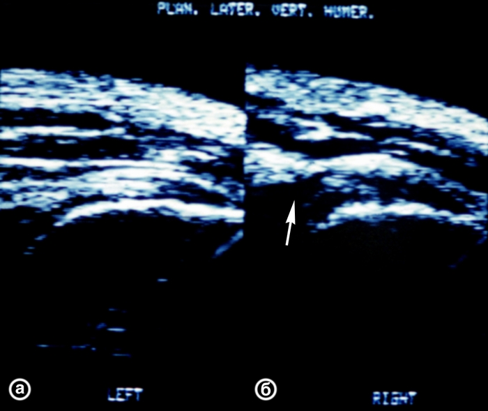 Рис. 16. Ультрасонограммы плечевых суставов (латеральный вертикальный срез) в норме (а) и при частичном разрыве сухожилия надостной мышцы (б): на рисунке б контур сухожилия частично прерывается, место разрыва указано стрелкой