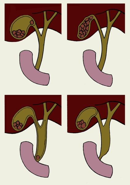Рис. 2. Схематическое изображение желчных путей при некоторых осложнениях желчнокаменной болезни: а — камни в желчном пузыре, один из них обтурировал его шейку, <a href=