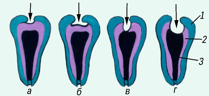 Схематическое изображение поражения зубов при различных формах кариеса: а — разрушение эмали (поверхностный кариес); б — поражение дентина (средний кариес); в — разрушение дентина (глубокий кариес); г — вскрытие полости зуба (осложненный кариес). Стрелками указаны кариозные полости, цифрами — структуры зуба, поражаемые при кариесе (1 — эмаль, 2 — дентин, 3 — <a href=