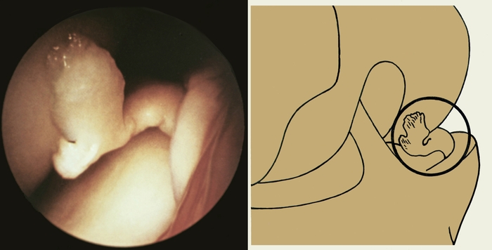 Рис. 2г). Артроскопия менисков — паракапсулярный разрыв внутреннего мениска до переднего его рога, фрагмент мениска смещен в межмыщелковую область