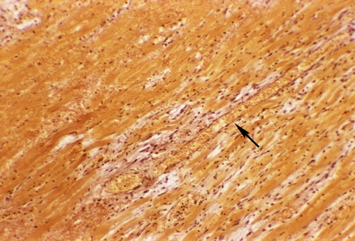 Рис. 6. Микропрепарат миокарда при ишемическом инфаркте с ранними признаками репарации: в левом верхнем углу видна зона некроза, а в прилежащем к ней миокарде — многочисленные фибробласты вокруг сосуда (указан стрелкой); <a href=