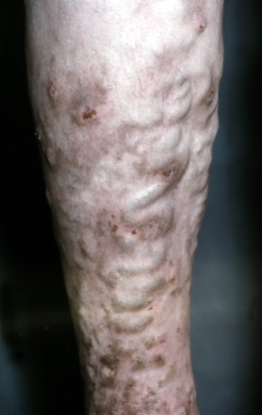 Рис. 2. Варикозное расширение поверхностных вен голени с явлениями дерматита, пигментацией и изъязвлениями кожи