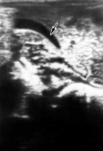 Рис. 3а). Ультразвуковая сканограмма желчного пузыря в норме: неизмененный желчный пузырь указан стрелкой