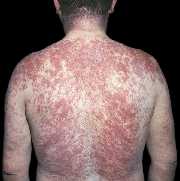 Рис. 7. Аллерготоксикодермия, вызванная бисептолом: эритема с геморрагическими элементами на коже спины и верхних конечностей